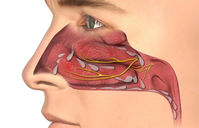 Medical cross-section illustration of inflamed nasal turbinates, nerves, and excess mucus in allergic rhinitis