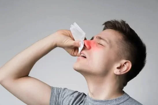 Young man pinching red inflamed nose with tissue stopping nosebleed at Center of ENT Lahore