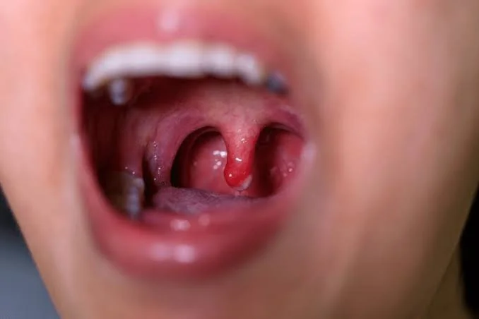 Open mouth view showing swollen red uvula and throat inflammation examined at Center of ENT Lahore
