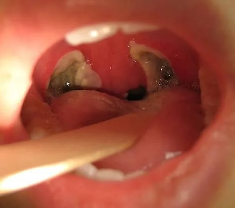 Oral examination showing white fibrin healing slough in tonsillar beds after tonsillectomy at Center of ENT Lahore
